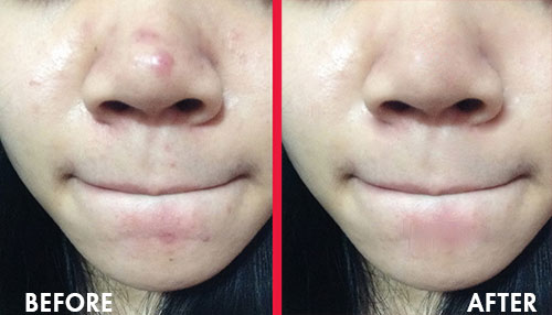 Mụn bọc ở mũi: Cách xử lý nhanh chóng với tinh chất chấm mụn Am to Pm 5 cach chua mun boc o mui