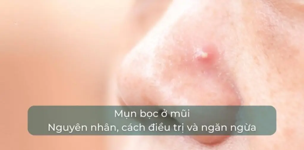 Mụn bọc ở mũi: Cách xử lý nhanh chóng với tinh chất chấm mụn Am to Pm 2 mbb