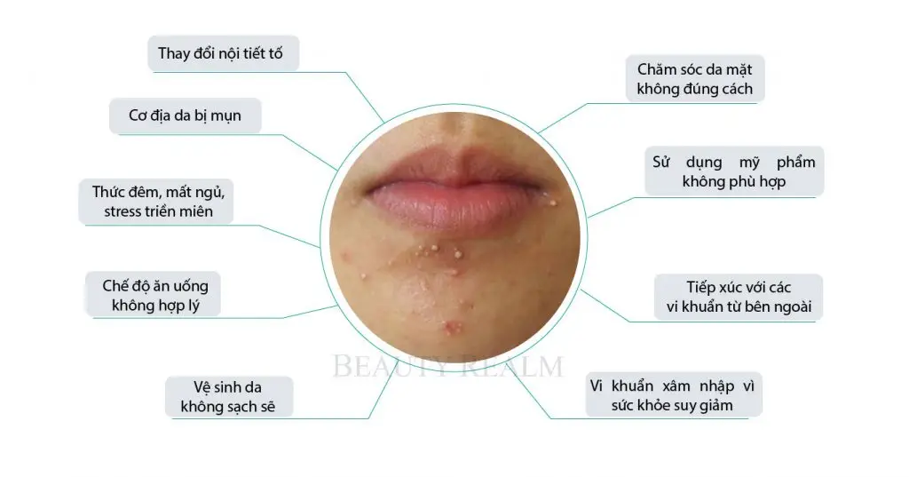 Nguyên nhân gây mụn bọc ở cằm và bí quyết xử lý không để lại thâm 1 Mụn bọc ở cằm