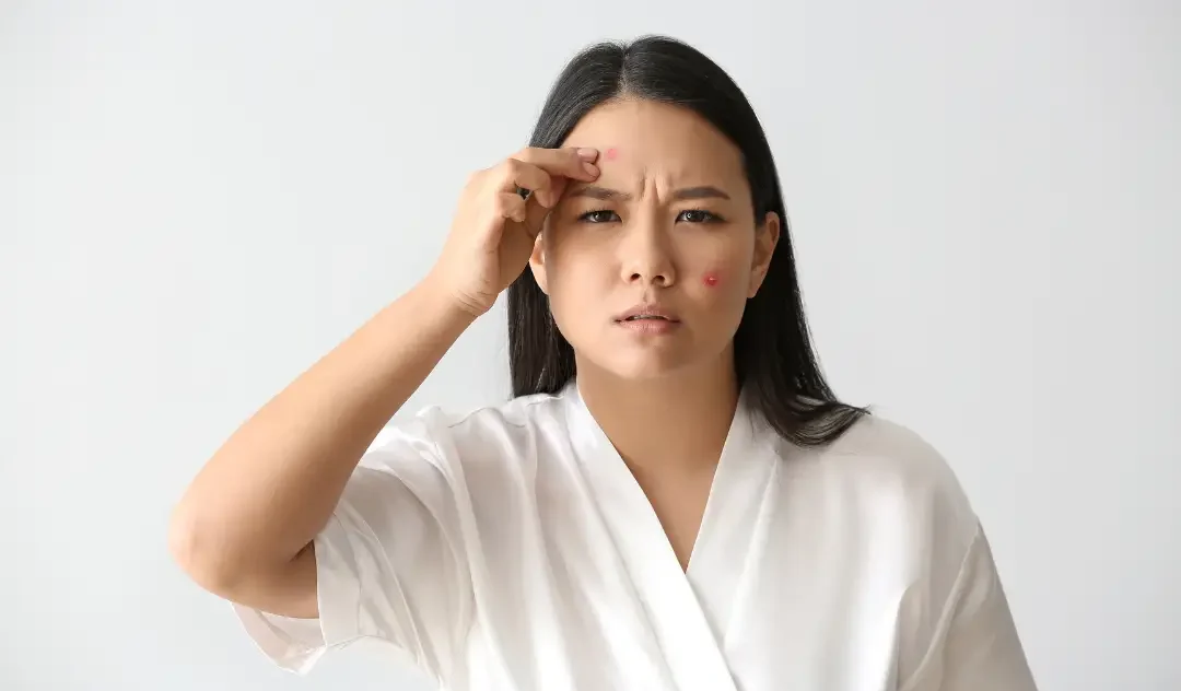 Cách Trị Mụn Viêm An Toàn, Hiệu Quả Mà Không Để Lại Thâm Sẹo 1 mụn viêm