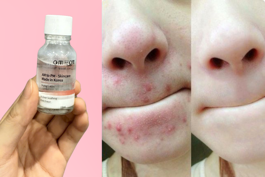 Cách Chọn Sản Phẩm Chấm Mụn Viêm