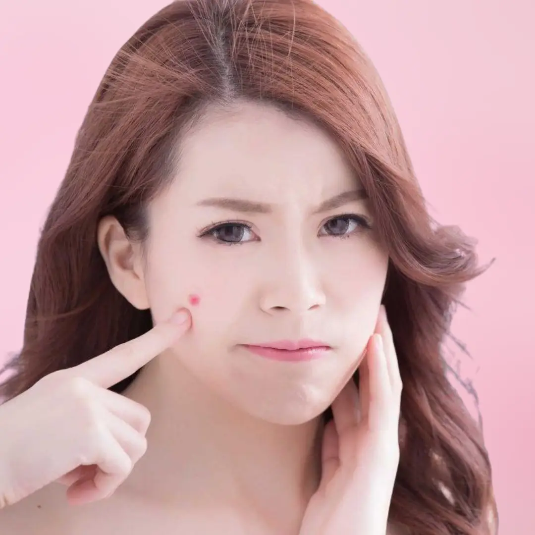 mụn bọc ở má